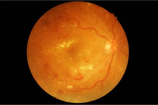 Diabetic Eye Care at MedEye Associates in Pembroke Pines, FL featured image