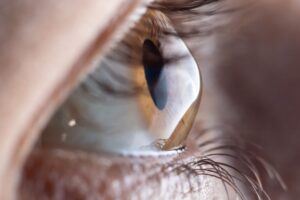 Cornea Care in Pembroke Pines, FL featured image